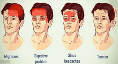 Sinus Headaches