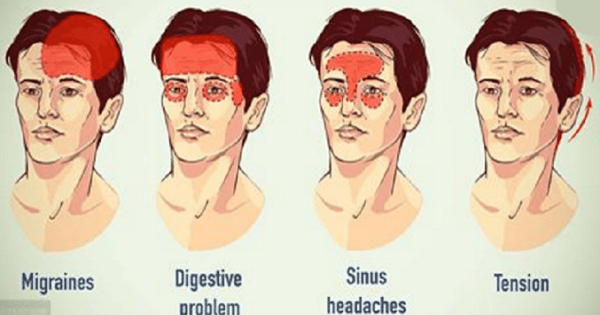 Sinus Headaches